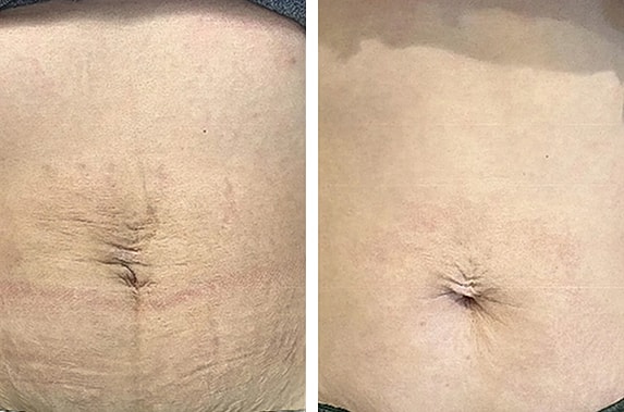 Before and after images of abdominal area.