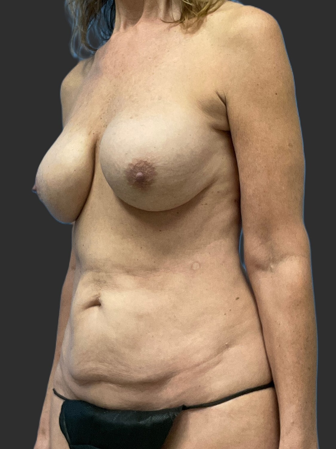Mini Tummy Tuck Before & After