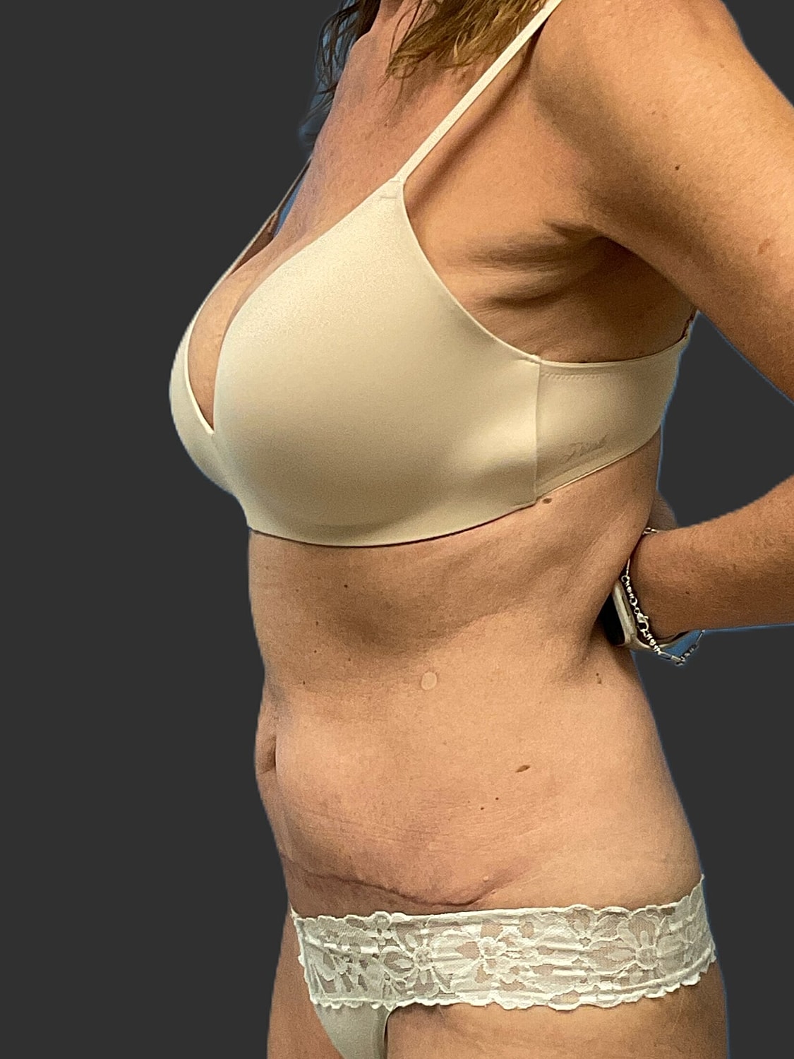 Mini Tummy Tuck Before & After
