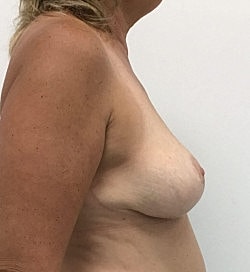 Breast Lift Before & After