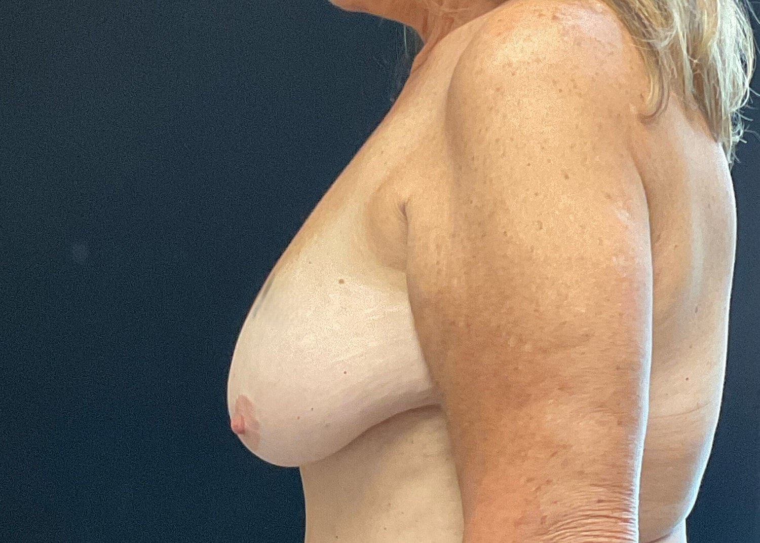 Breast Lift Before & After
