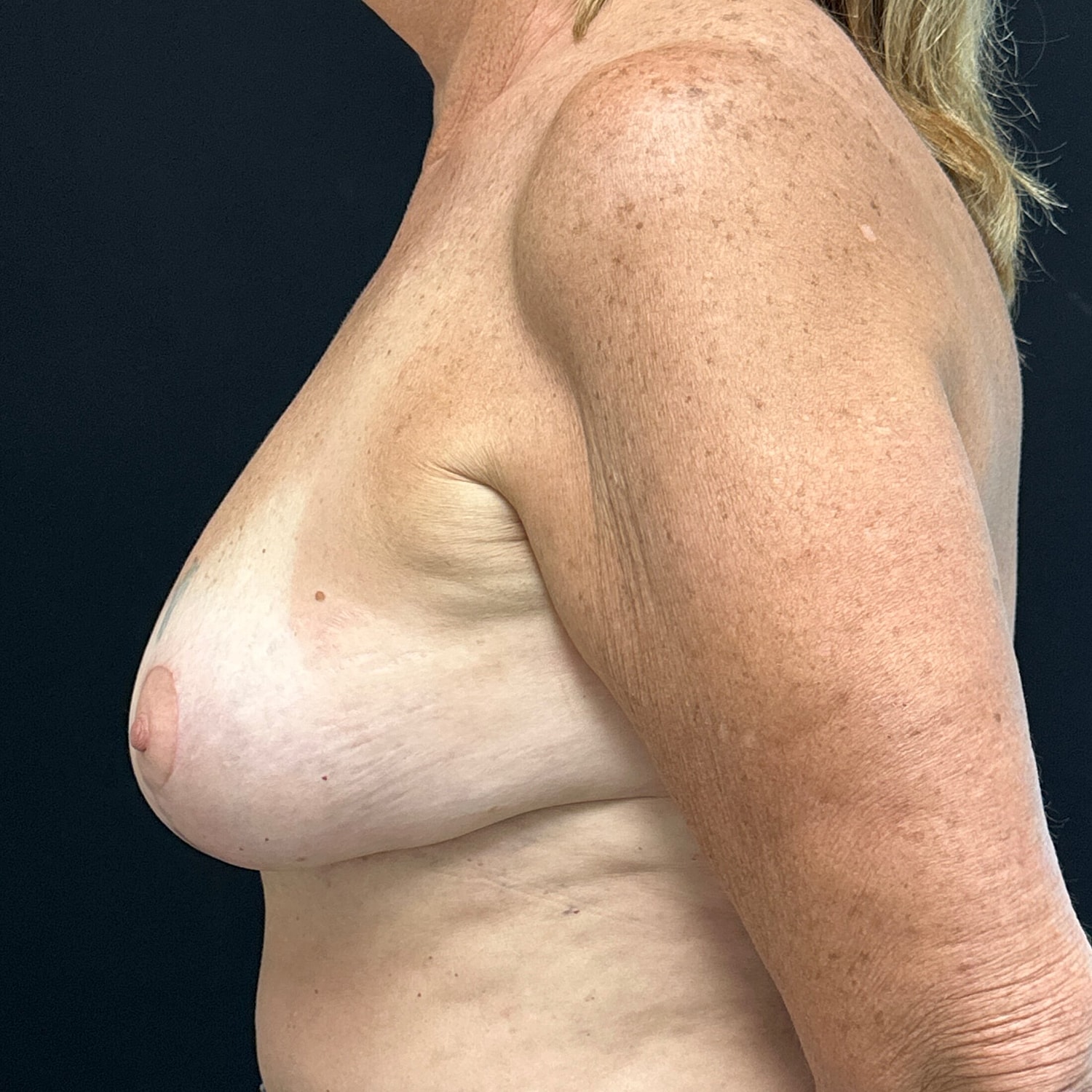 Breast Lift Before & After