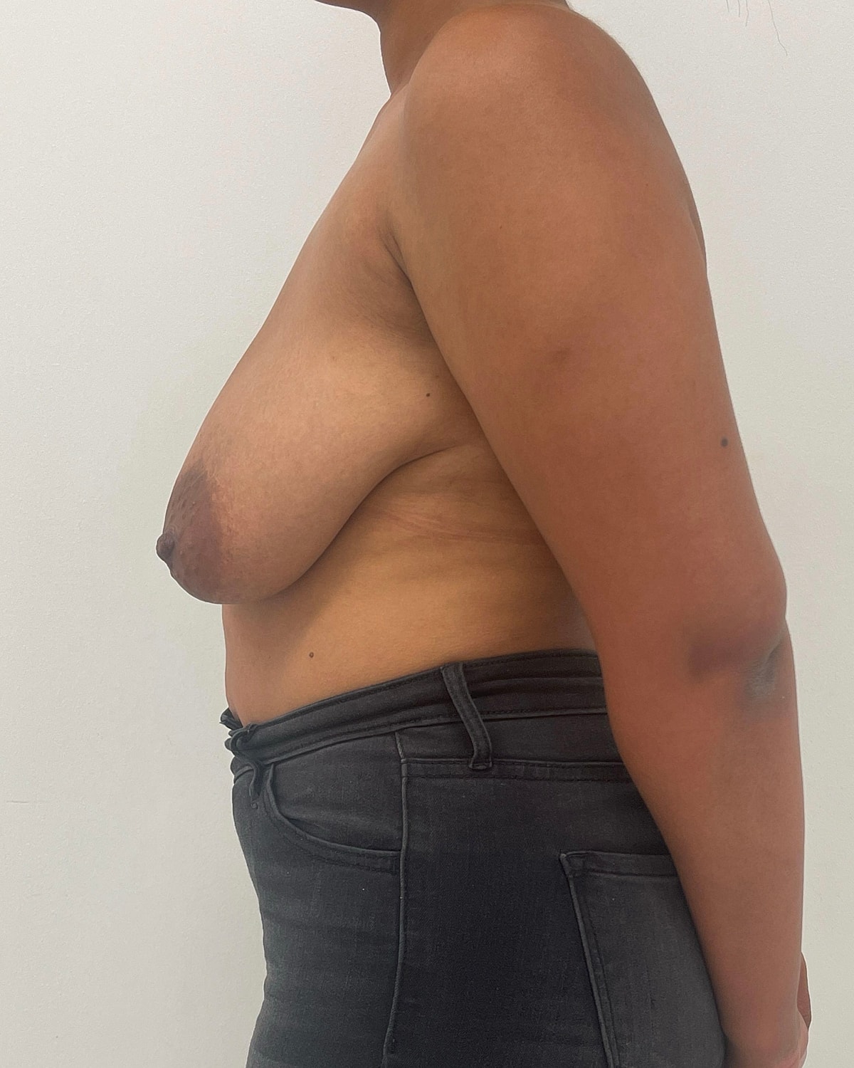 Breast Lift Before & After