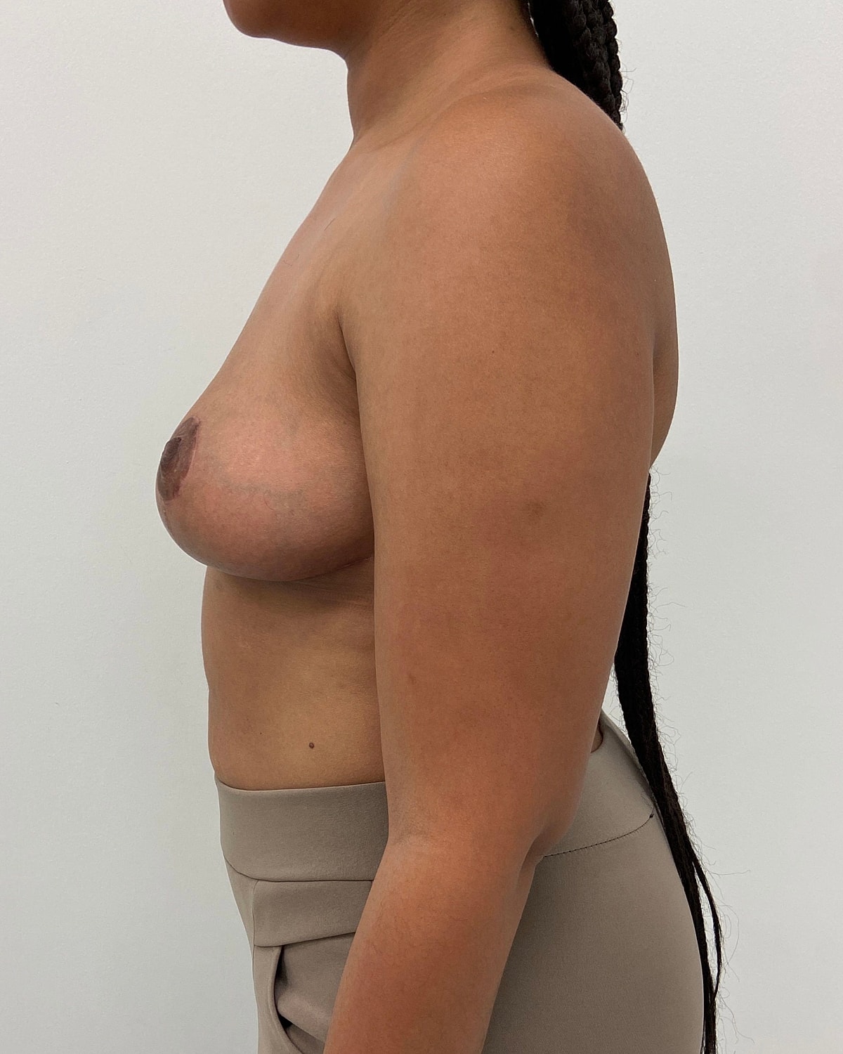 Breast Lift Before & After