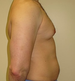 Gynecomastia Surgery Before & After