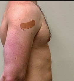 Gynecomastia Surgery Before & After