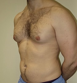 Gynecomastia Surgery Before & After