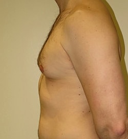 Gynecomastia Surgery Before & After
