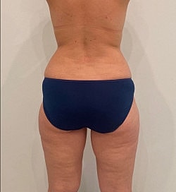 Abdominoplasty Before & After