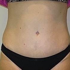 Abdominoplasty Before & After