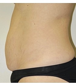 Abdominoplasty Before & After
