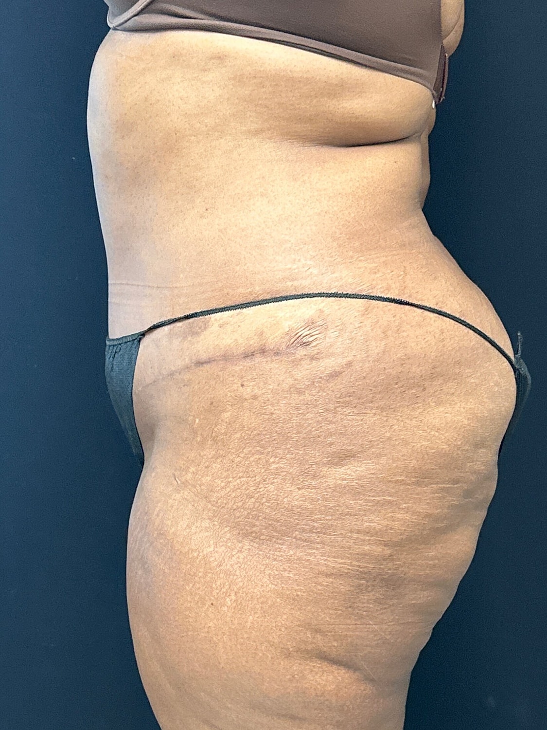 Tummy Tuck Before & After