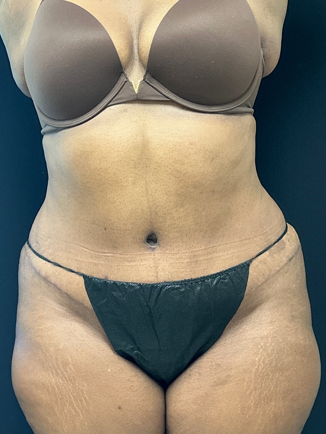 Tummy Tuck Before & After