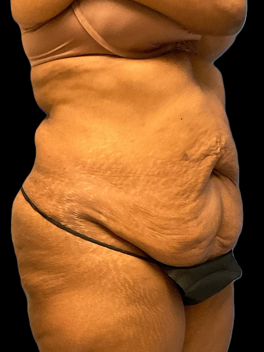 Tummy Tuck Before & After