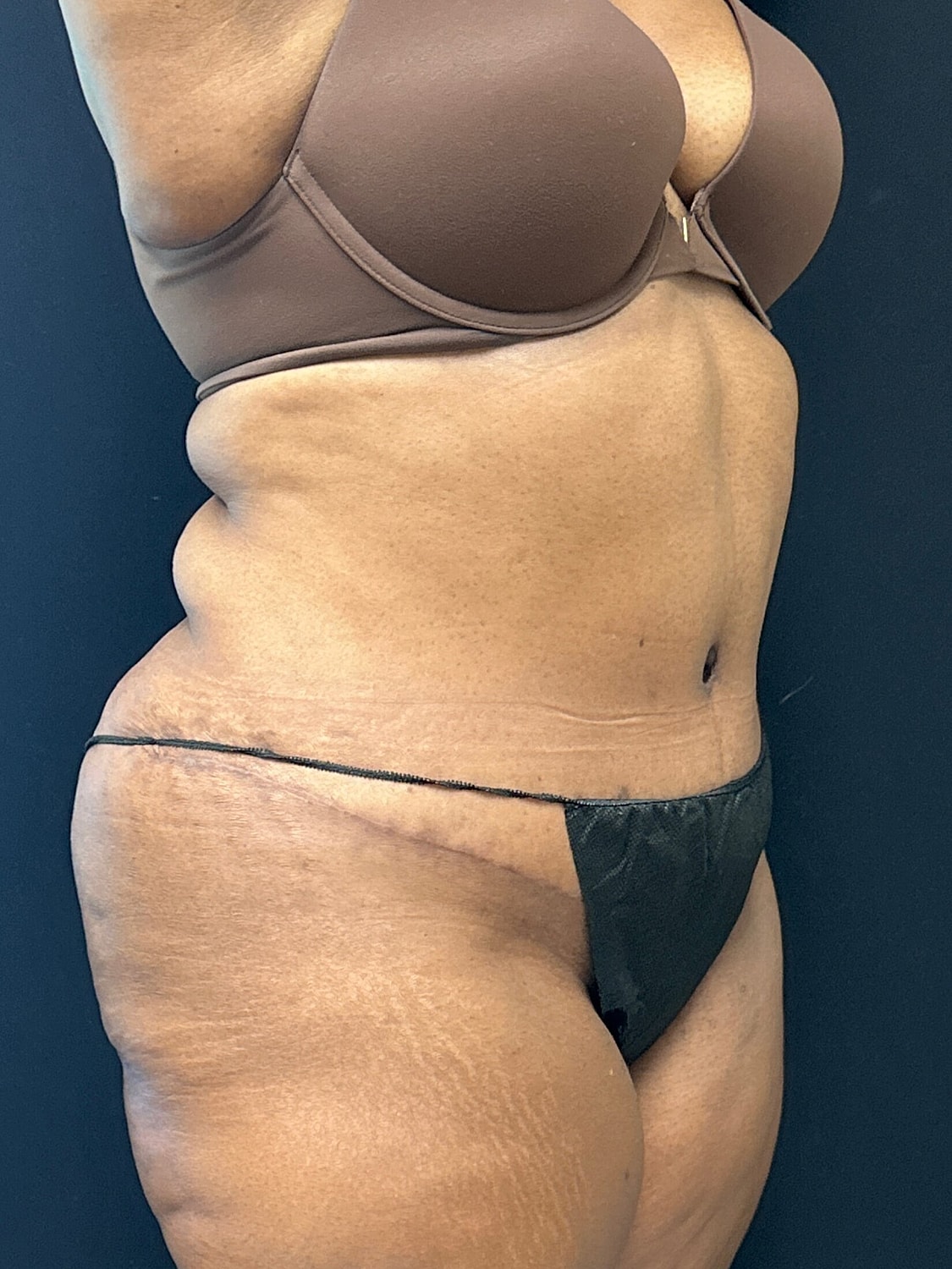 Tummy Tuck Before & After