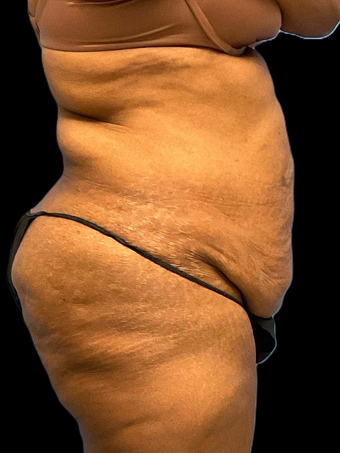 Tummy Tuck Before & After