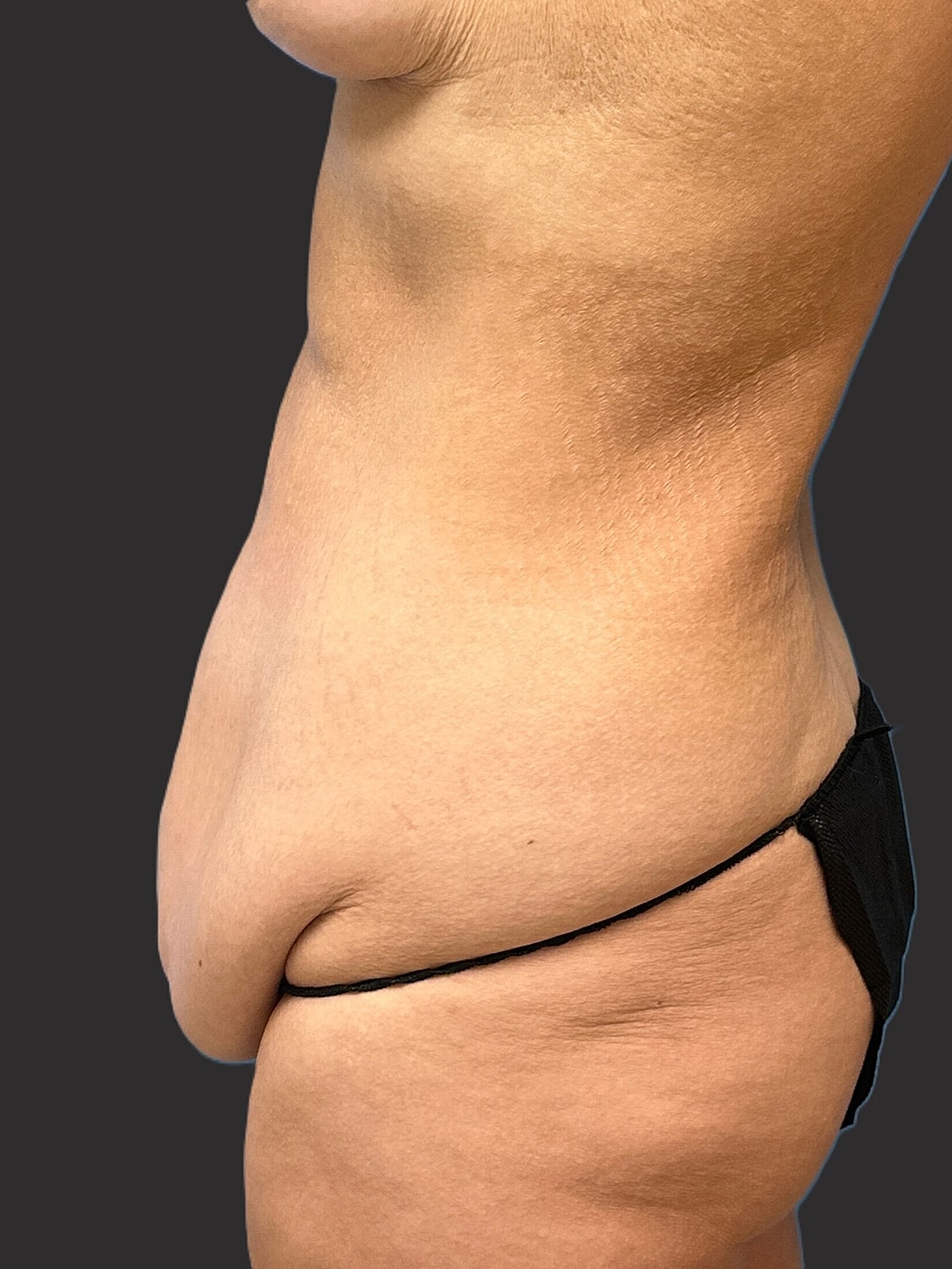 Tummy Tuck Before & After