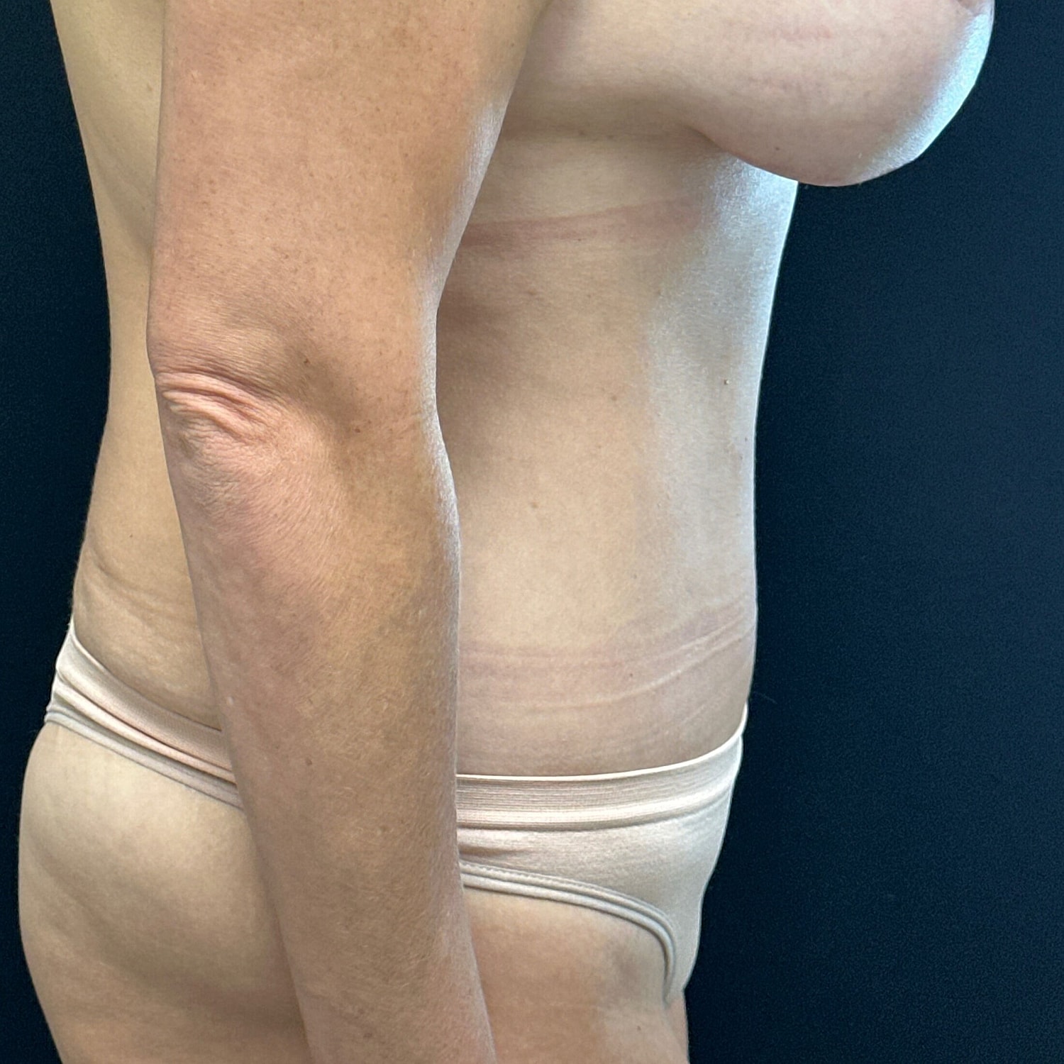 Tummy Tuck Before & After