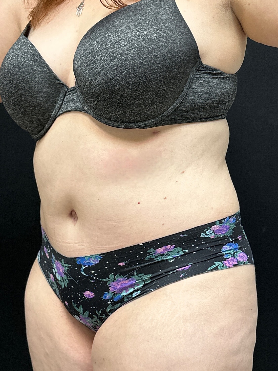 Tummy Tuck Before & After