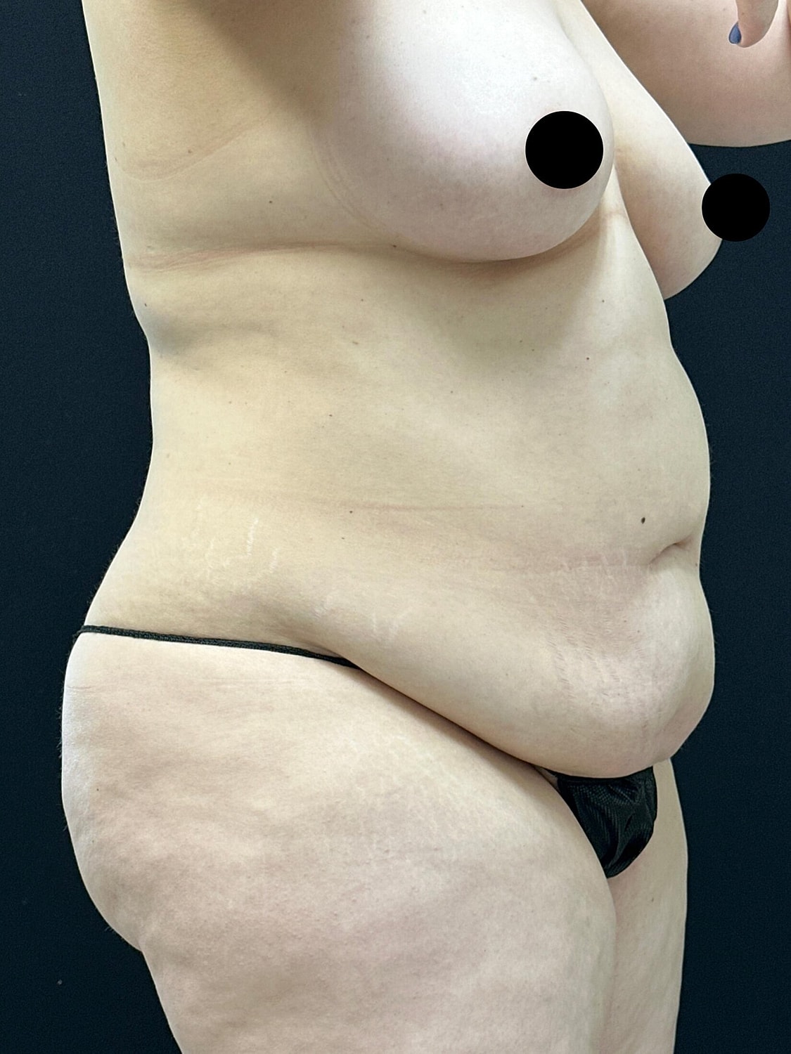 Tummy Tuck Before & After