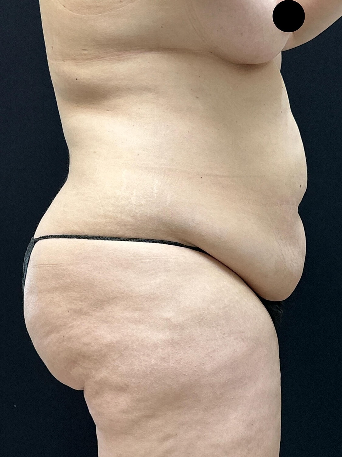 Tummy Tuck Before & After