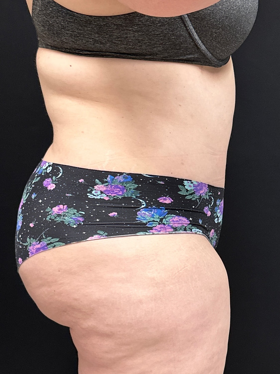 Tummy Tuck Before & After