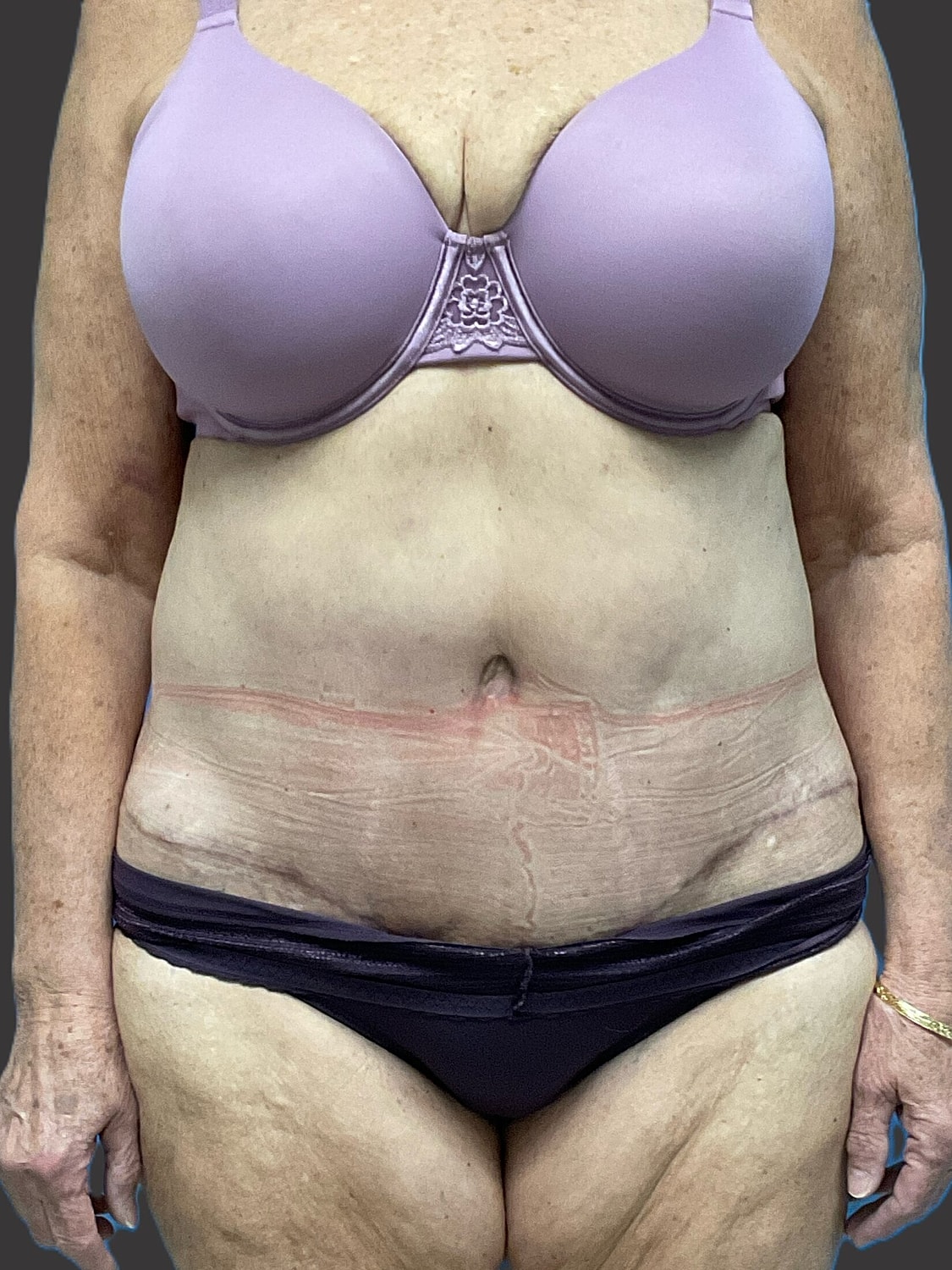 Tummy Tuck Before & After