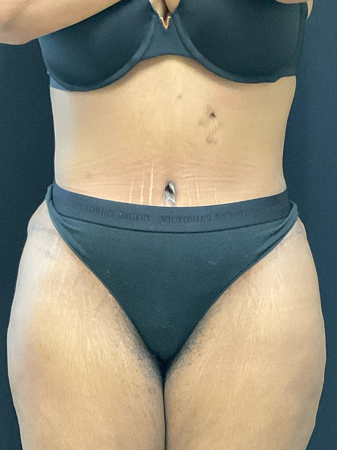 Tummy Tuck Before & After