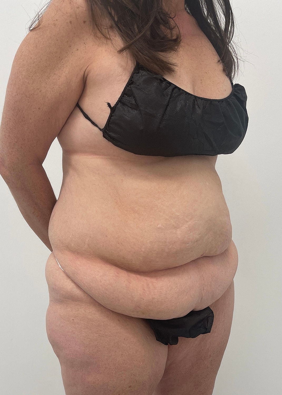 Tummy Tuck Before & After