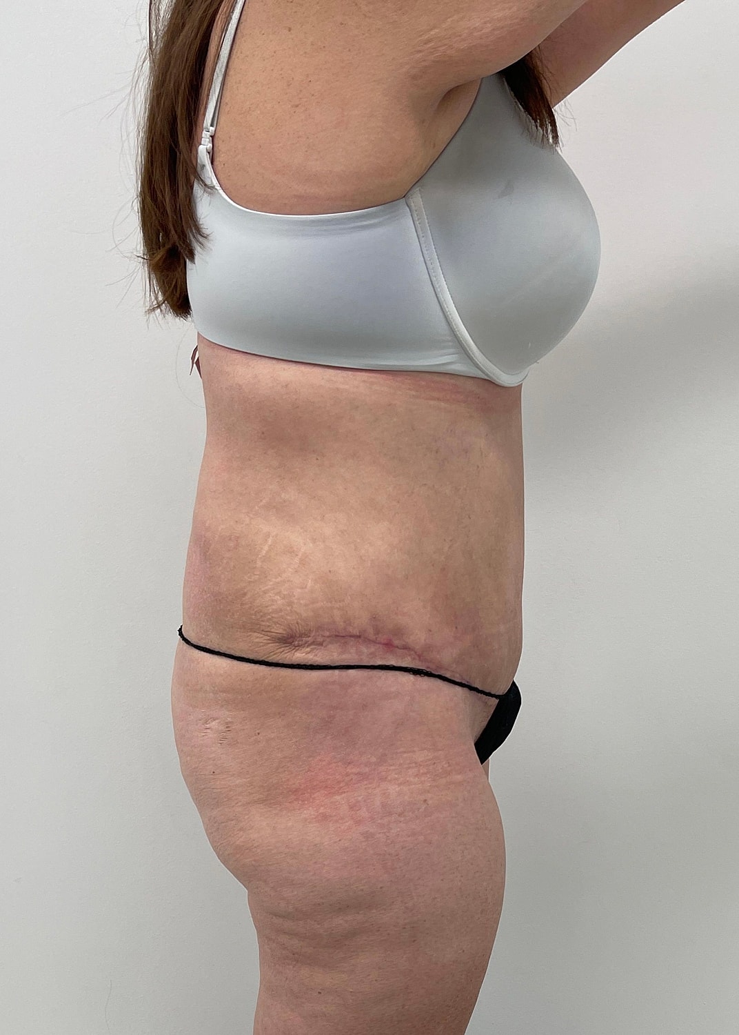 Tummy Tuck Before & After