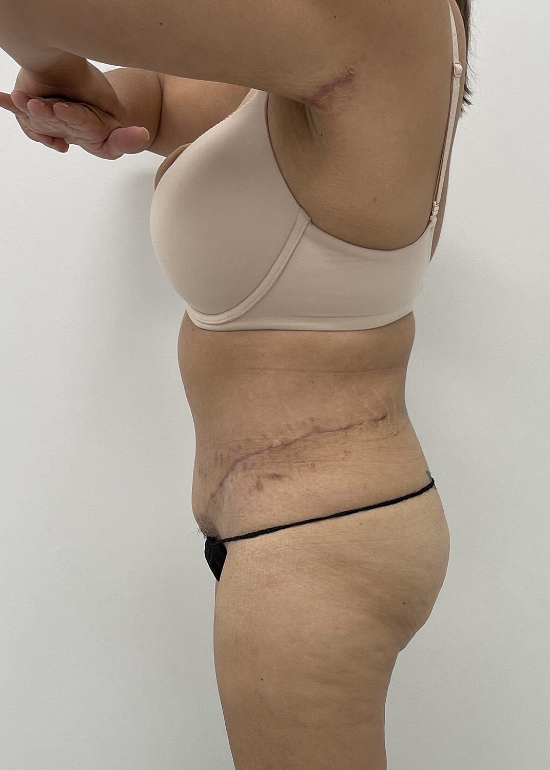 Tummy Tuck Before & After