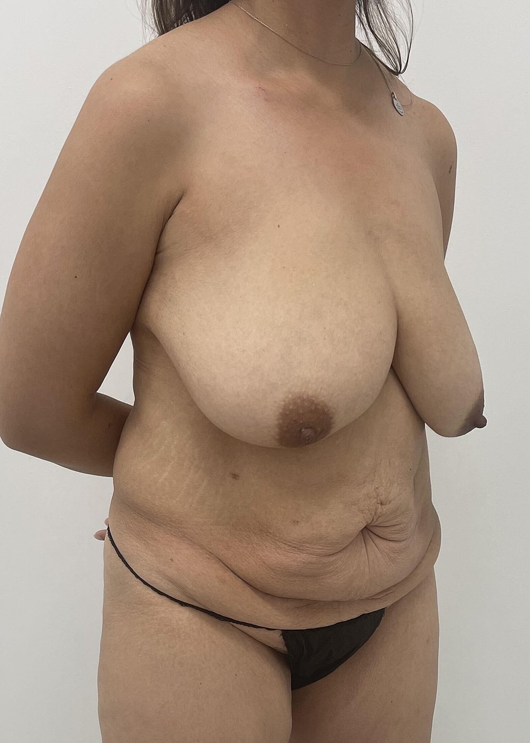 Tummy Tuck Before & After