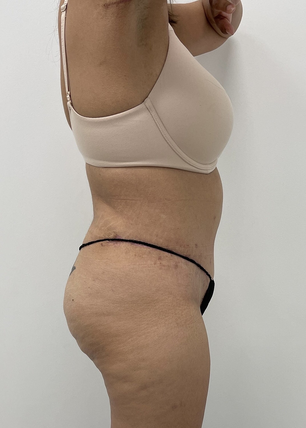 Tummy Tuck Before & After