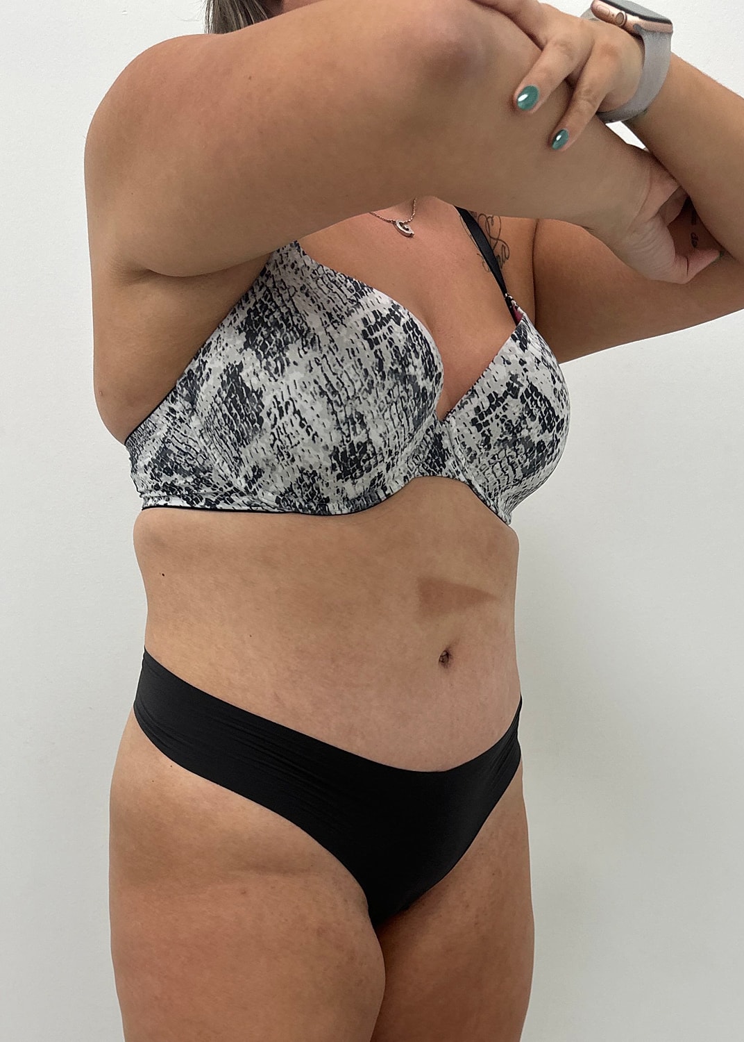 Tummy Tuck Before & After