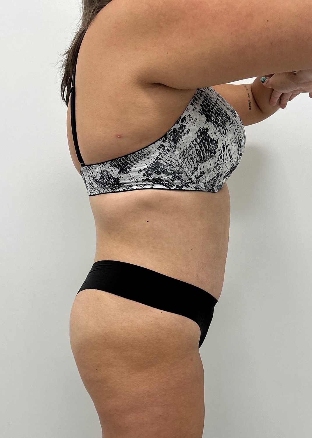 Tummy Tuck Before & After