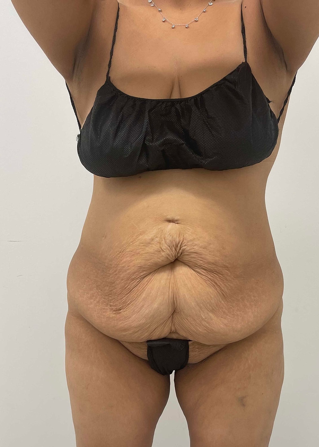 Tummy Tuck Before & After