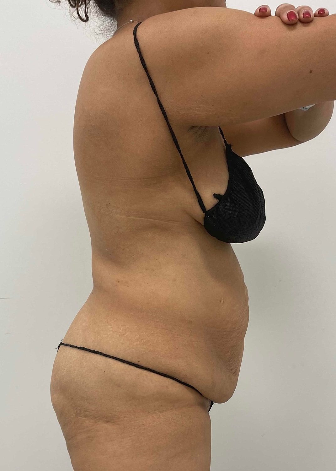 Tummy Tuck Before & After