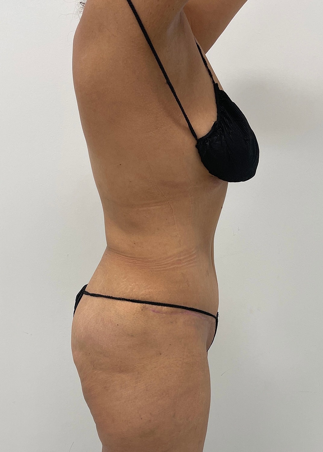 Tummy Tuck Before & After