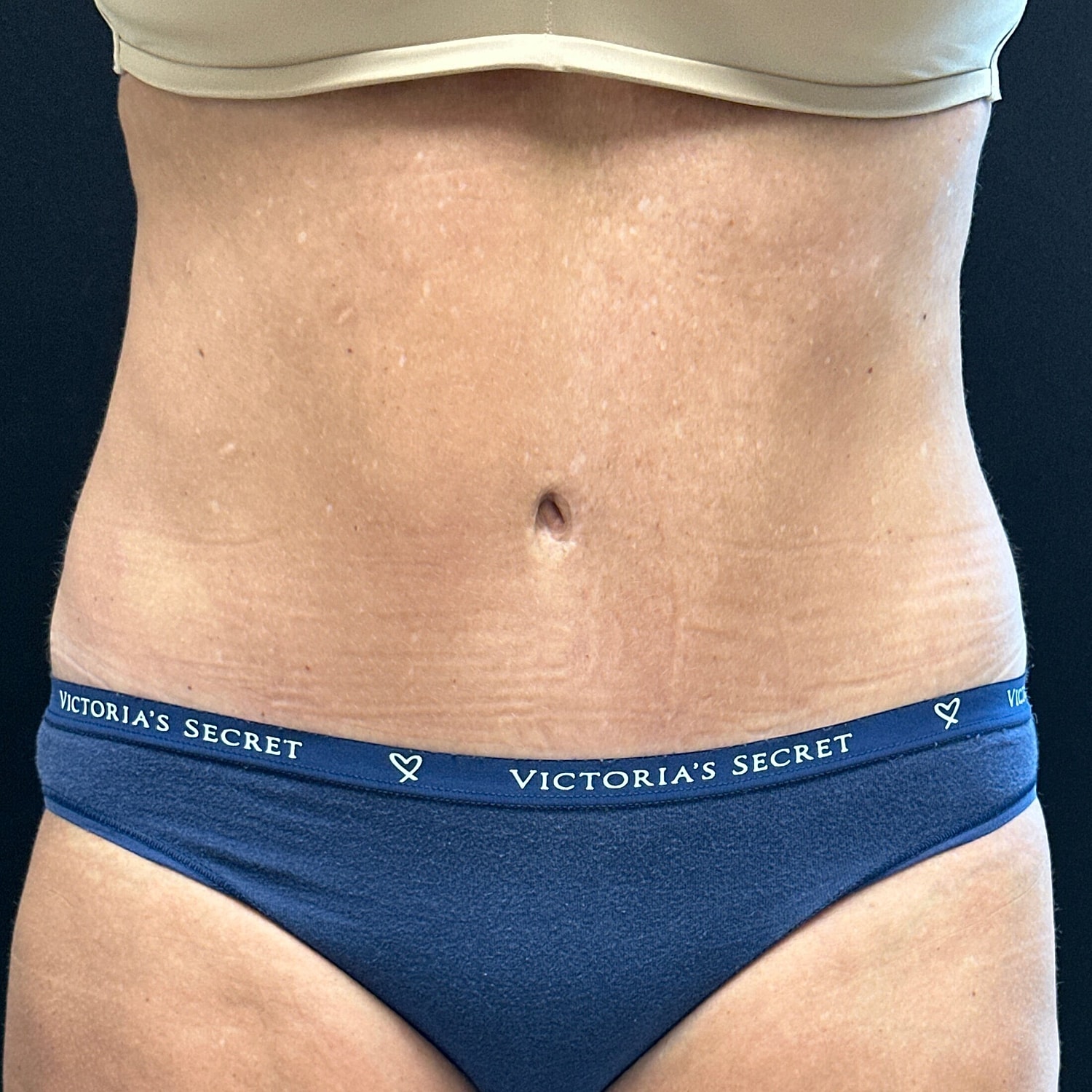 Tummy Tuck Before & After