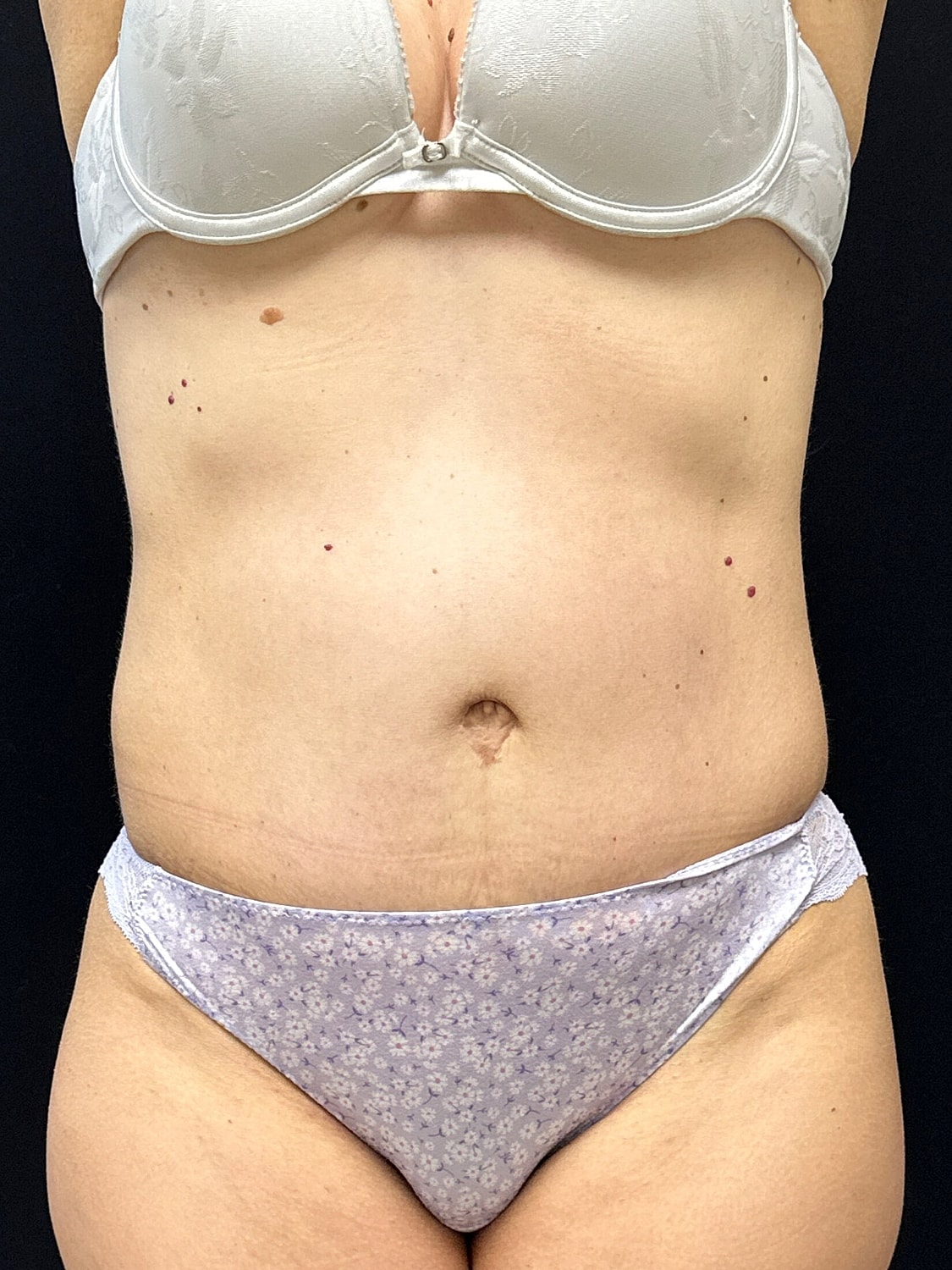 Tummy Tuck Before & After