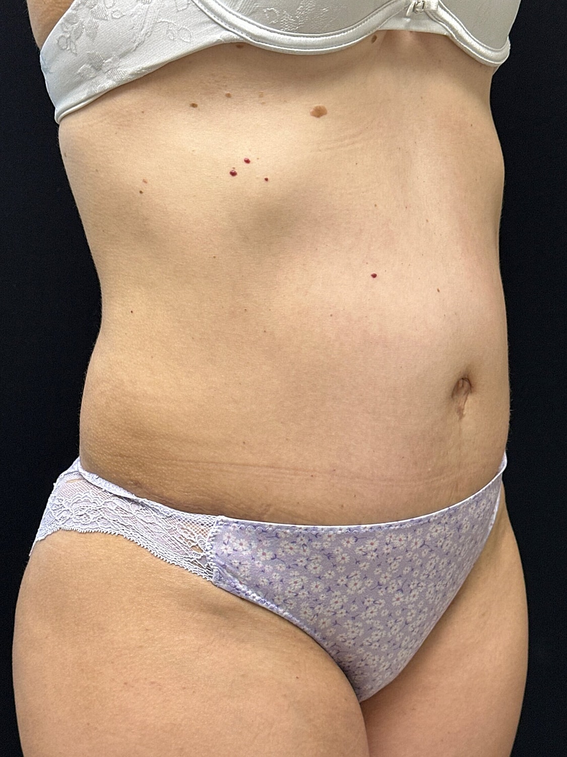 Tummy Tuck Before & After
