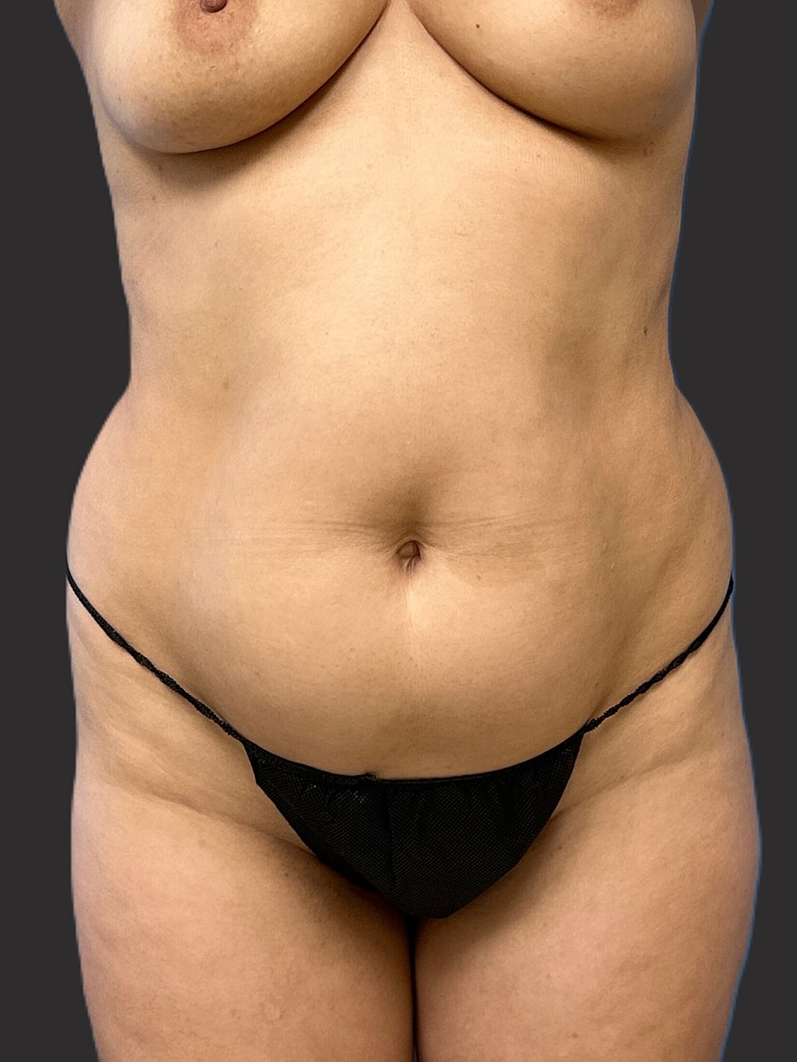 Tummy Tuck Before & After