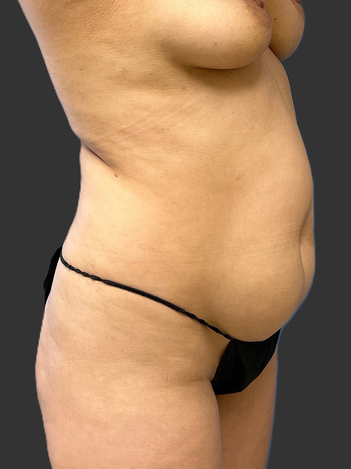 Tummy Tuck Before & After