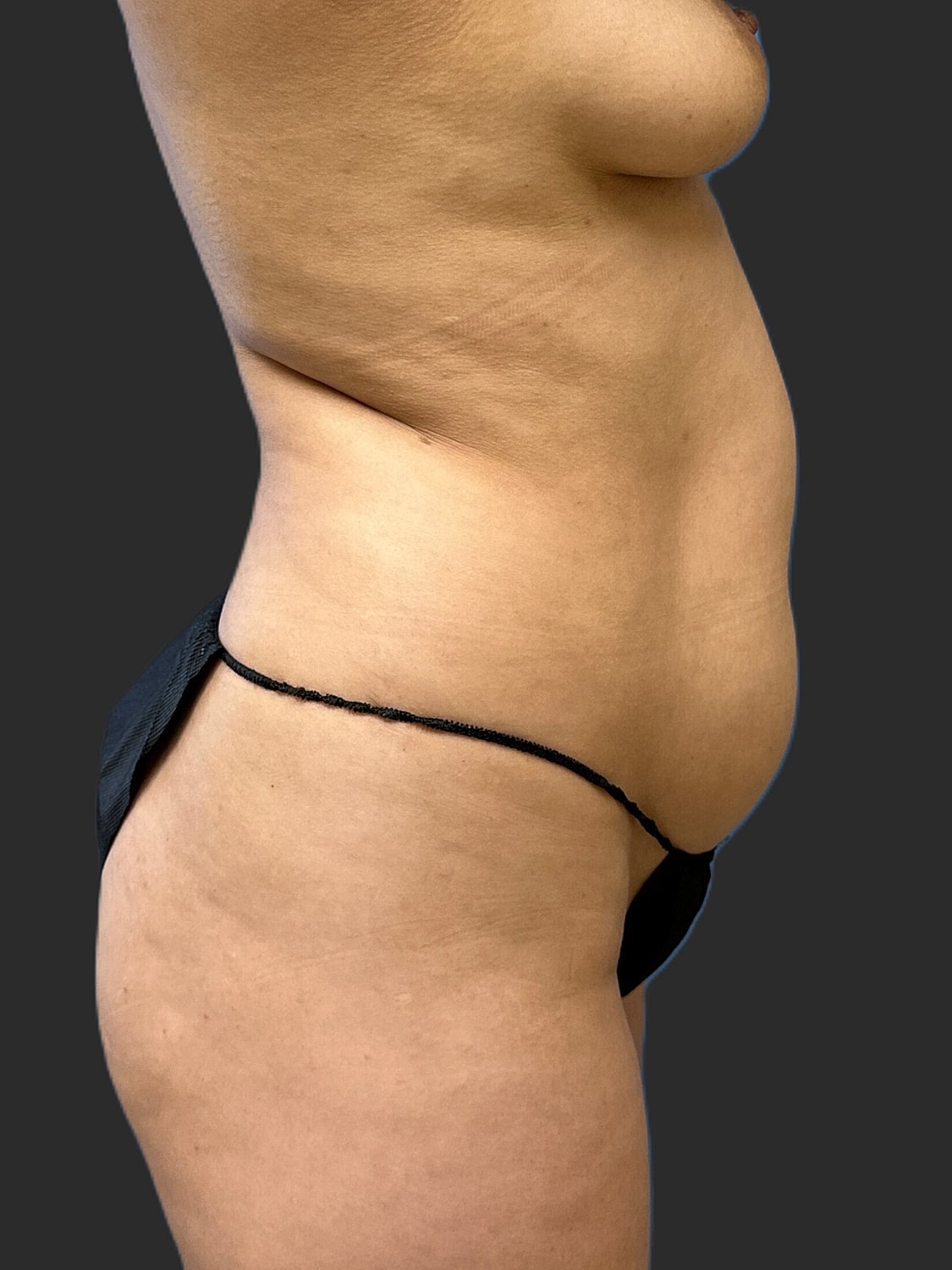 Tummy Tuck Before & After