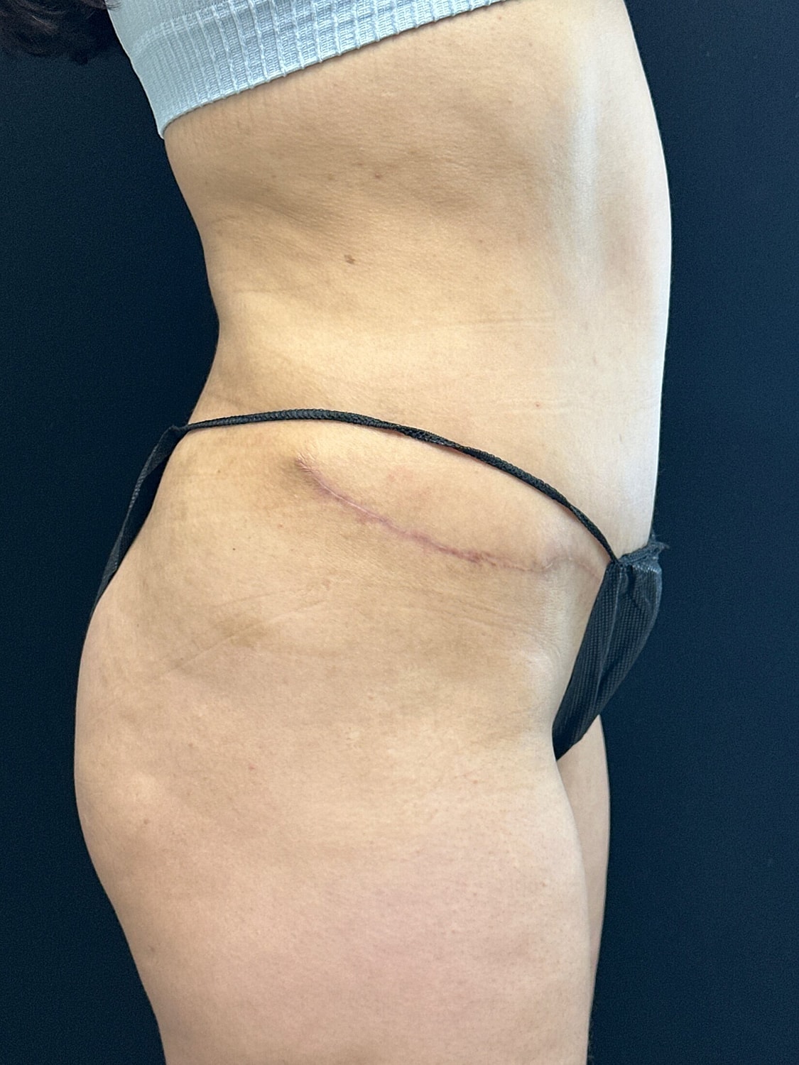 Tummy Tuck Before & After
