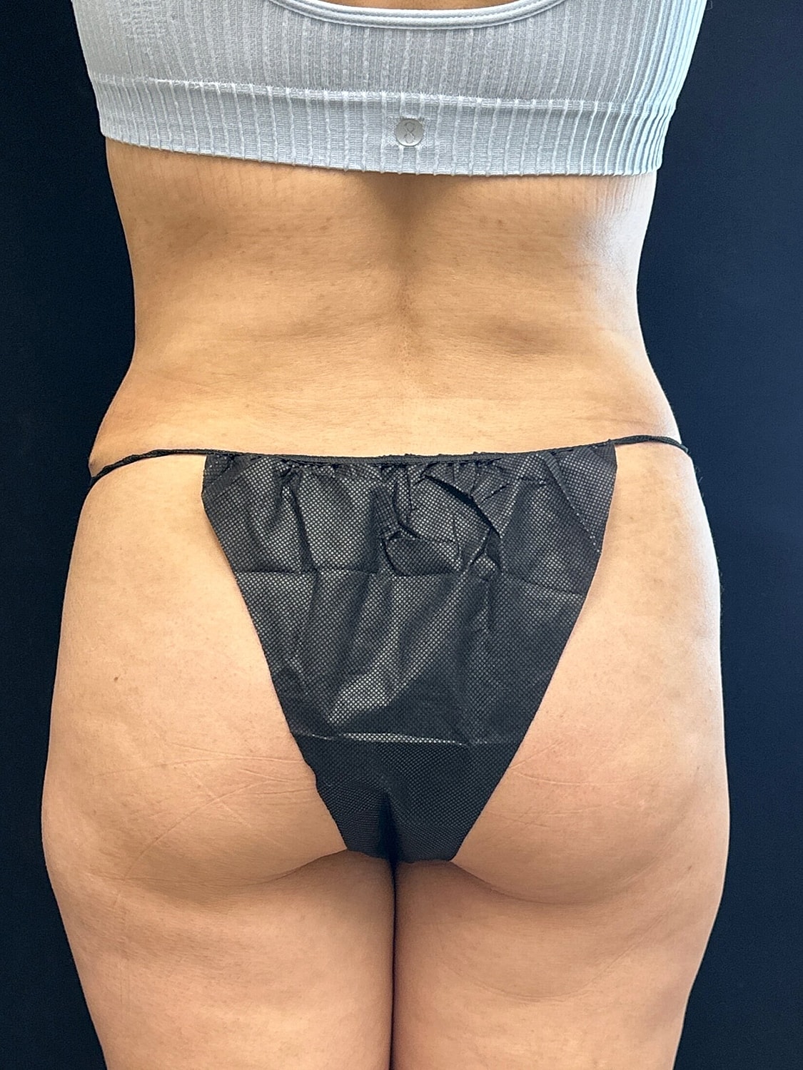 Tummy Tuck Before & After