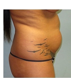 Brazilian Butt Lift Before & After