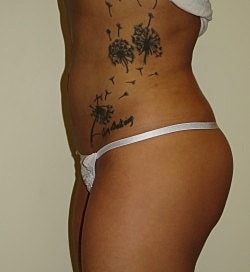 Brazilian Butt Lift Before & After