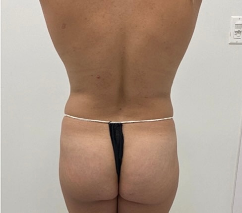 Brazilian Butt Lift Before & After
