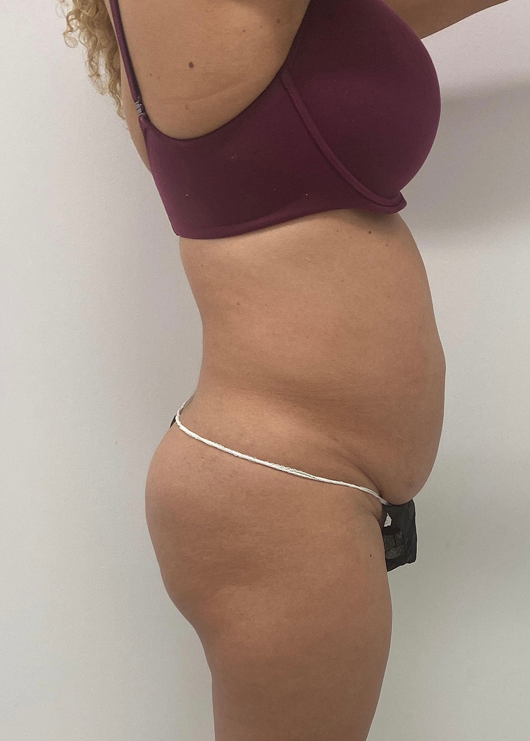 Brazilian Butt Lift Before & After